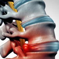 Can I Get Workers’ Compensation for a Herniated Disc?