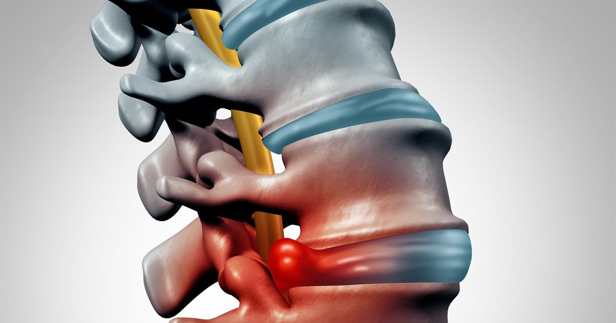 Workers’ Compensation for a Herniated Disc
