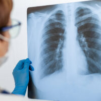 Are Occupational Lung Diseases Covered Under Workers’ Compensation?